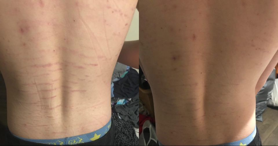 STRETCHLESS™ Stress Less Over Stress Marks!